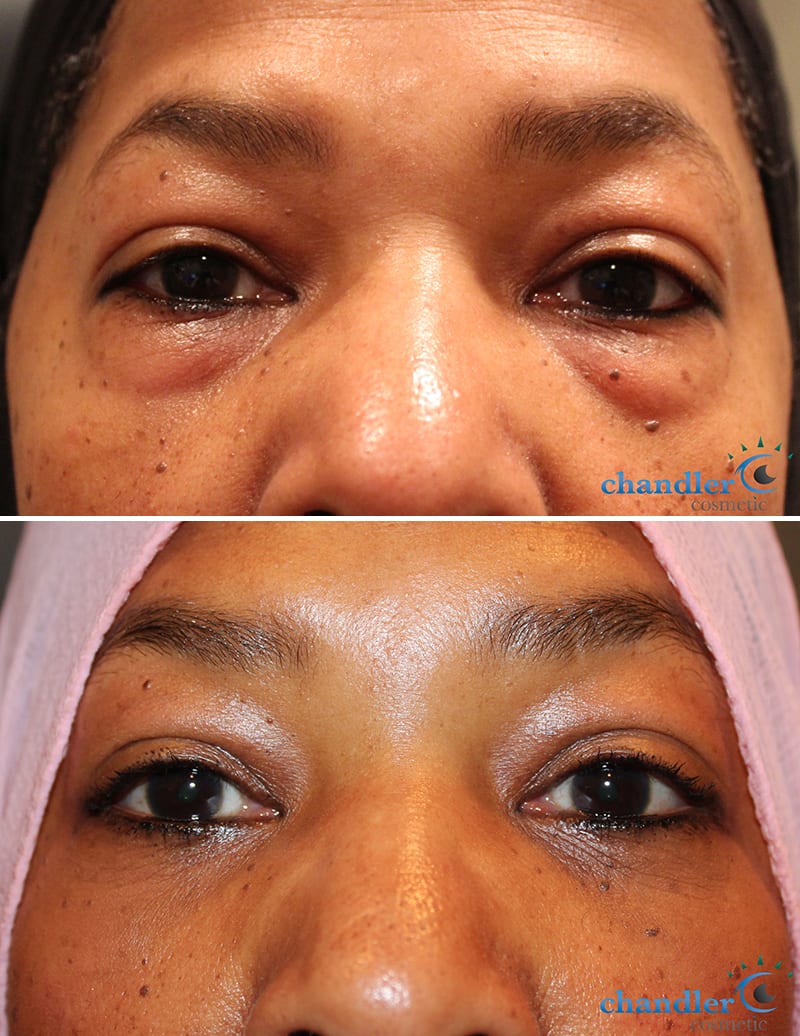 Lower Blepharoplasty Eyelid Surgery Philadelphia PA