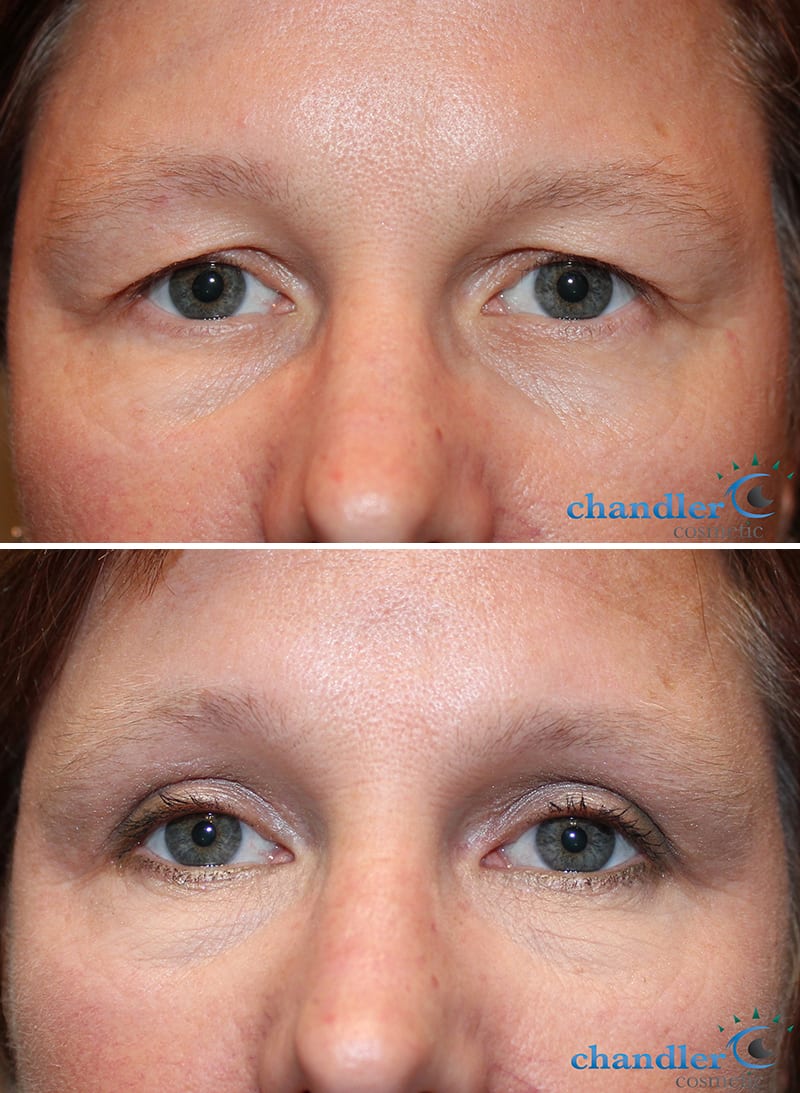 Upper Blepharoplasty Healing Process Joseph Walrath Md WOOLFSON EYE