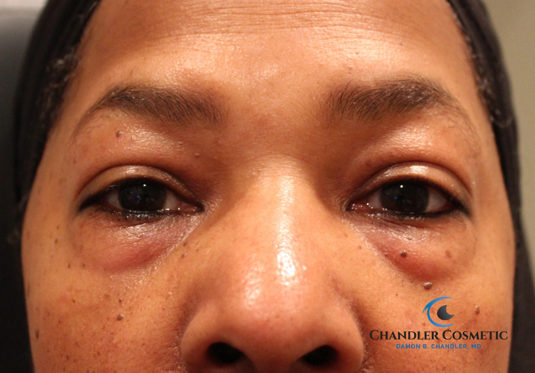 Lower Blepharoplasty Eyelid Surgery | Philadelphia PA