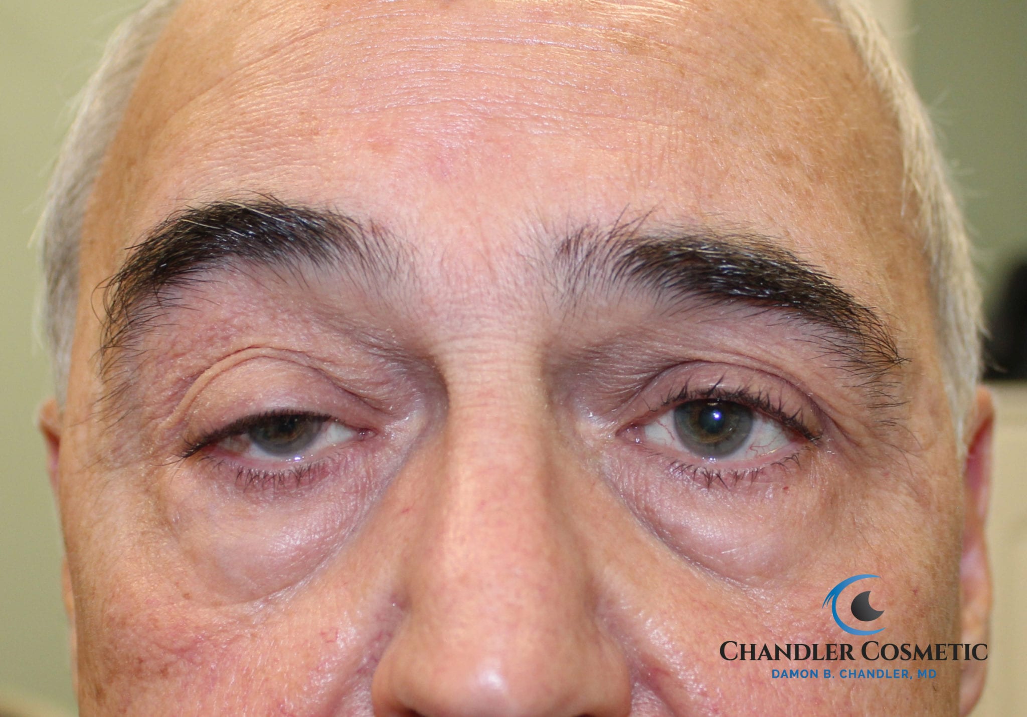 droppy eyelid surgery droppy eyelid surgery