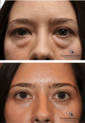 under eye surgery