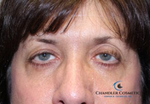 ptosis surgery eyelid lift eyelid surgery woman before