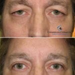 upper blepharoplasty eyelid surgery man before after